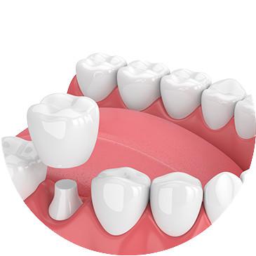 China Beautiful Dental Crowns And Bridges Smooth Surface For Oral Hygiene Safety for sale