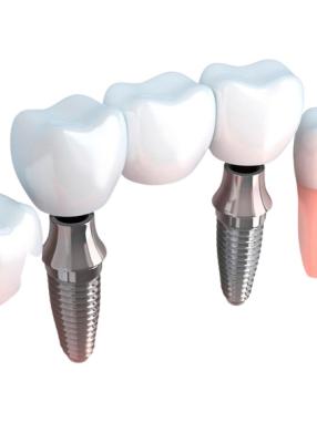 China Realistic Appearance Bridges And Dental Crowns Strong Stability Natural Color for sale