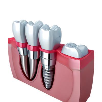 China Elevating Standards Our Dental Implant Crown Quality Assurance en venta