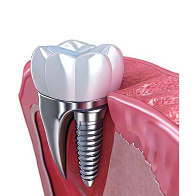 Chine The Strength Behind Our Success Our Dental Implant Crown Technicians à vendre