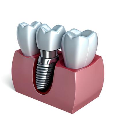 Chine The Journey To A Healthy Smile Our Dental Implant Crown Process à vendre