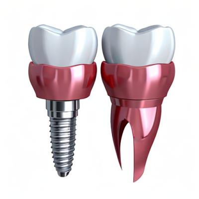 China Bridging The Gap Our Role In Enhancing Oral Health With Dental Implant Crowns for sale