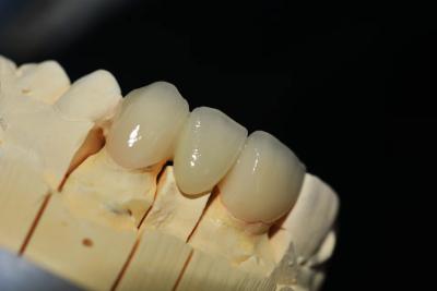 Κίνα Customized Zirconia Denture Dental lab - Fast Delivery and Repair προς πώληση