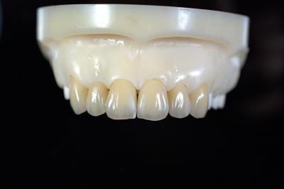 Cina Customized Zirconia Denture Dental lab - Fast Delivery and Repair in vendita