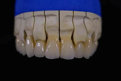 China Denture Fabrication Lab Achieving Perfectly White Dentures with Zirconia Repair à venda