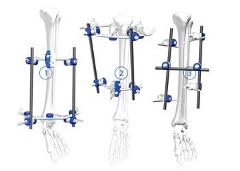 China El trauma ortopédico flexible implanta la fijación tibial del externo del marco de la meseta en venta