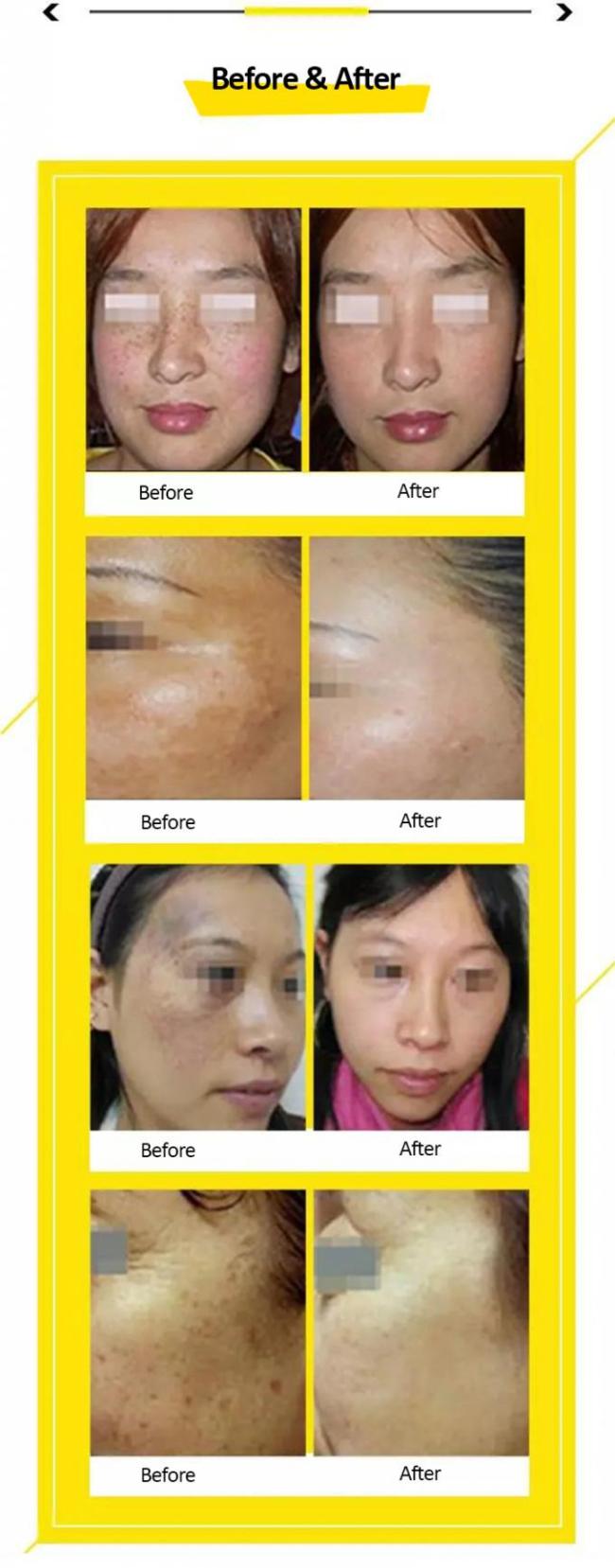 Picosecond Laser Tattoo Removal 1064nm&532nm Device With Korean 7 Joint Articulated Arm 1